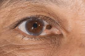 (to learn about how cancers start and spread, see what is the most common type of eye cancer is melanoma. Should I Be Worried There Is A Brown Spot On My Eye Book An Eye Test