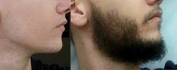 You may not believe but its like they grow in one night, my forehead, ears, chin, all over my face is all hair and all around my eyes. Good Or Bad Does Rogaine Really Help Grow A Beard