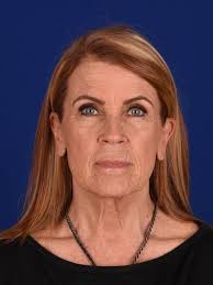 Best Facelift in Scottsdale, AZ