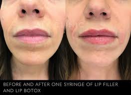 Before and After Photos of Fillers in Nashville