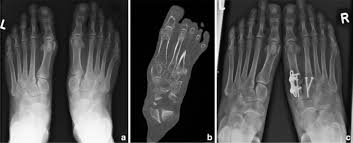 A lisfranc injury is a tarsometatarsal fracture dislocation characterized by traumatic disruption between the articulation of the medial cuneiform and base of the second metatarsal. Retrospective Analysis Of Treatment Decisions And Clinical Outcome Of Lisfranc Injuries Operative Vs Conservative Treatment Springerlink
