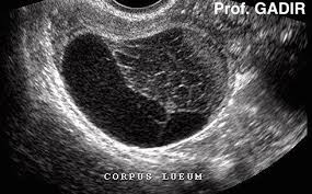 Image result for corpus luteum sonography)