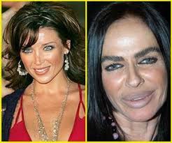 Celebrity Before And After Plastic Surgery Michaela Romanini Plastic Surgery Celebrity Plastic Surgery Bad Celebrity Plastic Surgery Botched Plastic Surgery