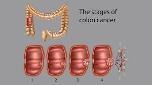Lung cancer symptoms on stage 4 before death lung cancer is a common dangerous pathology that occurs in a malignant form. Colon Cancer Stages What Do They Mean For Survival Everyday Health