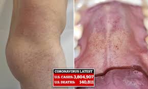 Pimples inside the mouth may also be due to burning sensation. Red Rash Like Splotches In The Mouth May Be A New Symptom Of Coronavirus Study Suggests Daily Mail Online
