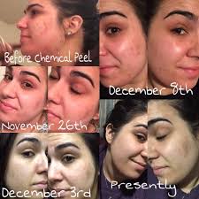 Ever taken a high 3* shadow and purified for a perfect??