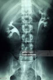 Image result for Intravenous Pyelogram