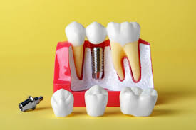 Choosing Between Single Tooth and Multiple Teeth Implants