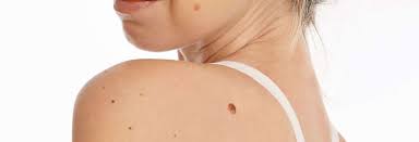 Skin cancer is one of the most common types of cancer. Benign Mole Skin Tag Removal Treatment Cosmetic Clinic Newcastle Ccm