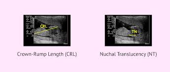 Image result for First Trimester Ultrasound
