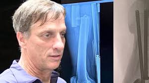 Tony Hawk si è fratturato gravemente una gamba in un incidente di  skateboard : r/sports