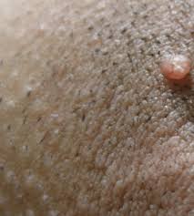 Topical creams including steroids normally lower swelling and irritation or swelling on the skin part with the cyst. Ingrown Pubic Hair Cyst Infected Get Rid Of It Treatment And Pictures Healthrid