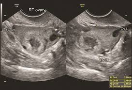 Image result for corpus luteum sonography)