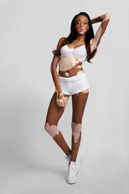 Exclusive Interview With Antml Cycle 21 Chantelle Young Chantelle Young Eliminated Contestant From Antm Her Model Winnie Harlow Winnie Harlow Next Top Model