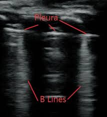 Image result for Transfusion Associated Circulatory Overload
