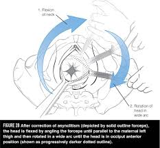 Another study showed that oasis rates were slightly higher with kielland's forceps than with rotational ventouse (2.5% to 0%) (3). Get A Handle On The Scanzoni Maneuver