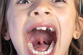 Image result for papillomavirus tongue)