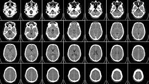 Best Dicom Viewer For Android Brain Tissue Traumatic Brain Injury Aspergers