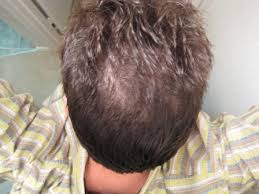The link between the two after identifying its success in treating dandruff, scientists began looking into its ability to manage seborrheic dermatitis. 2 Nizoral For 5 Month Everyday Hairlosstalk Forums