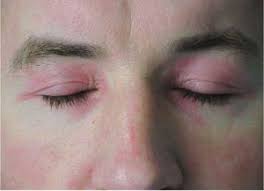 Image result for Dermatomyositis