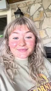 Did any of you get acne post accutane??? What did you do to help it,  besides going back