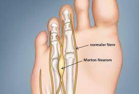 Morton Neurom Ortho Clinics Webseite
