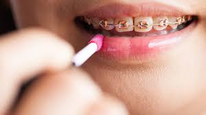 However, do it yourself braces is not one of them. Braces Colors What Colors Are Available And How To Choose