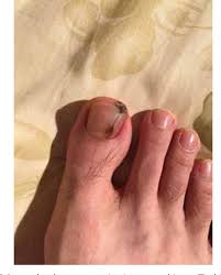 Image result for Acral lentiginous melanoma nail