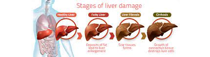 When i visited large bookstores in jakarta and kl i am indonesian and i have lived in malaysia, so i suppose it was natural that this question fell to my hands. Fatty Liver Columbia Asia Hospital Malaysia