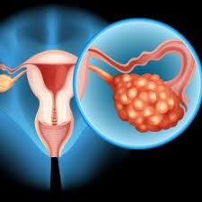 You may find the ovarian cancer article more useful, or one of our other health articles. Ovarian Cancer Ovarian Cancer Symptoms Medlineplus
