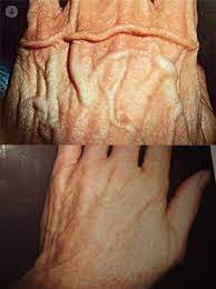 Thankfully, these are all pretty easy to get and we will describe the process below. Is It Possible To Remove Bulging Veins In The Hand