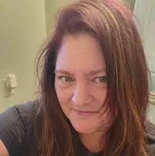 Any remedies for severe sunburn besides aloe and lotion?