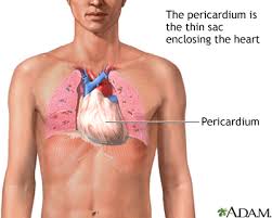 Image result for Pericarditis