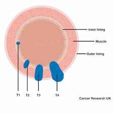 Bowel cancer is a term for cancer that begins in the large bowel. What Is Bowel Cancer Marie Keating Foundation