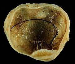 A dermoid cyst is a saclike growth that is present at birth. Dermoid Cyst Wikipedia