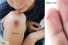 The treatment recommended by your doctor depends on your age, health and nature of your wound. Home Remedies For Minor Cuts And Grazes Top 10 Home Remedies