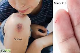 The treatment recommended by your doctor depends on your age, health and nature of your wound. Home Remedies For Minor Cuts And Grazes Top 10 Home Remedies