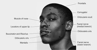 motor points of face for electrical stimulation of bells