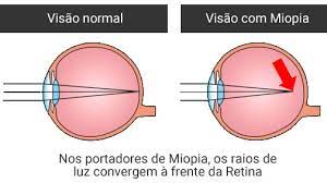 miopia em curitiba o que e causas e tratamento com cirurgia em curitiba dr artur schmitt