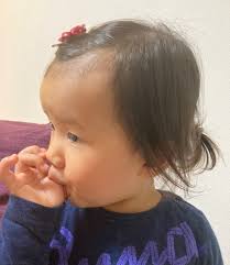 赤ちゃんおでこ？コブダイおでこ？が流行ってる | 皮膚科医mami先生のブログ