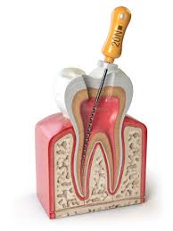 Price found to be important for oral and bone health are it contains hydroxyapatite, a mineral that naturally strengthens and whitens teeth. Root Canal Treatment Rct Huntington Beach Ca Affordable Immediate Pain Relief Orange County California Harbor Smiles