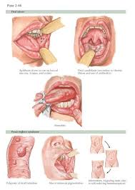 Oral Manifestations Of Gastrointestinal Diseases Inflammatory Bowel Diseases Ibds Mos Gastrointestinal Disease Inflammatory Bowel Disease Gastrointestinal