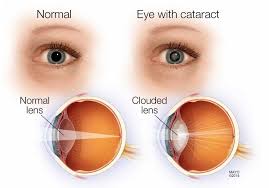 Curing Cataracts Without Surgery Cataract Surgery Cataract Cataract Symptoms
