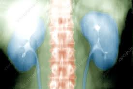 Image result for Intravenous Pyelogram