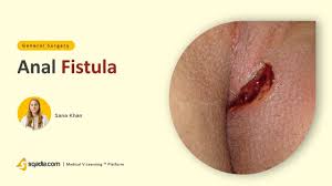 The most common type of surgery is a fistulotomy. Anal Fistula Surgery Online Video Lectures Medical Student V Learning Sqadia Com Youtube
