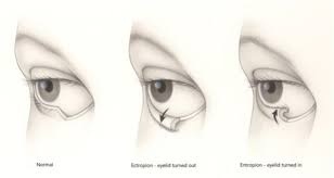 Image result for Entropion