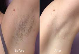 Wondering what the best facial hair remover is? Laser Hair Removal Elegance Medical Aesthetics Botox Cosmetic And Laser Clinic