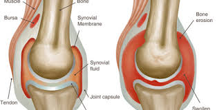 Lifestyle And Easy Home Remedies For Arthritis Articlecube