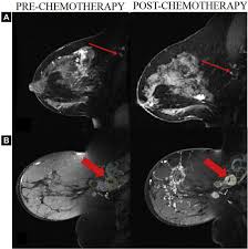 Need to have physical exam, mammogram, and ultrasound as needed. Mri Volume Changes Of Axillary Lymph Nodes As Predictor Of Pathologic Complete Responses To Neoadjuvant Chemotherapy In Breast Cancer Sciencedirect