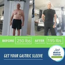 The weight loss after a gastric bypass operation has not only purely cosmetic effect, it also favorably impacts the metabolism. Gastric Sleeve Before And After Pictures Best Vsg Photos 2021
